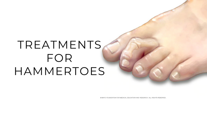 Treatments For Hammertoes