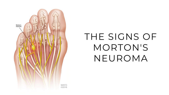 The Signs Of Morton's Neuroma