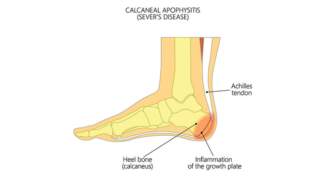 What you need to know about the Achilles tendon